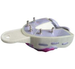 Miratray Implant horní S2, 6ks