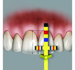 Chu Gauges T-BAR refill tips 3pcs./pack.