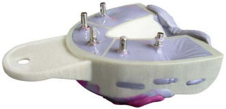 Miratray Implant dolní I1, 6ks